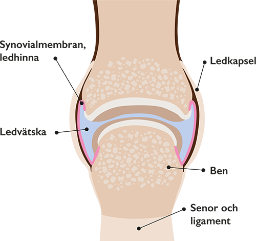 Reumatoid artrit orsaker