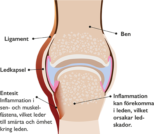 Psoriasisartrit orsaker